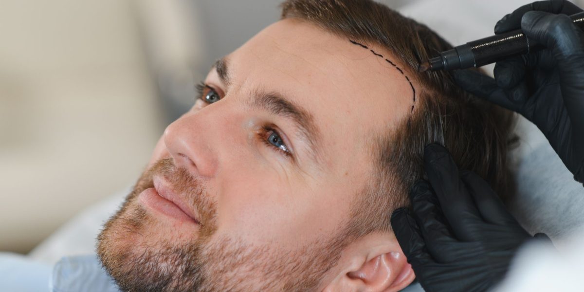 O descoperire promițătoare: Foliculi de păr umani, crescuți cu succes în laborator O echipă de cercetători din Statele Unite și Japonia a făcut un pas important în domeniul regenerării părului, reușind să creeze foliculi de păr complet funcționali în laborator