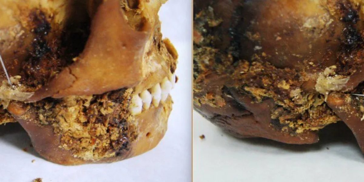 O femeie scită mumificată, operată la maxilar acum 2500 de ani: o descoperire uluitoare în Siberia Arheologii au făcut o descoperire remarcabilă în Siberia: o femeie scită, mumificată, a supraviețuit unei intervenții chirurgicale complexe la maxilar, acum aproximativ 2500 de ani