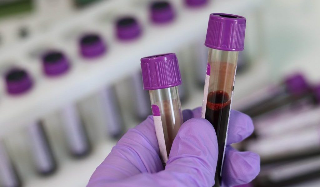 Un test de sânge ignorat crește riscul de infarct și accident vascular cerebral Un test de sânge relativ nou, dar încă subevaluat, ar putea schimba modul în care medicii estimează riscul de infarct miocardic și accident vascular cerebral