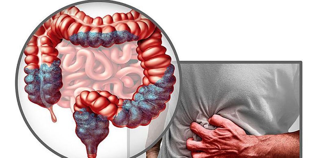 Cancerul colorectal, o boală tot mai frecventă la tineri: un studiu arată modificări în structura colonului Medicii avertizează asupra importanței unei diete echilibrate pentru prevenirea deficiențelor nutriționale și a riscului de cancer colorectal