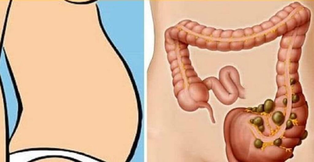 Constipația: Carențele de vitamine pot fi o cauză ignorată Constipația, o problemă digestivă comună care afectează persoane de toate vârstele, nu este întotdeauna doar rezultatul unui consum redus de fibre sau al lipsei de mișcare