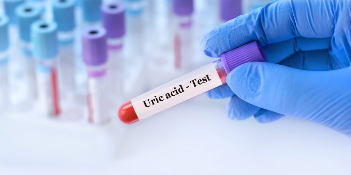 Acidul uric crescut: Cauze surprinzătoare și riscuri pentru sănătate Un rezultat neașteptat la analizele de sânge, anume nivelul ridicat de acid uric, poate stârni îngrijorare, mai ales când dieta nu este considerată un factor determinant