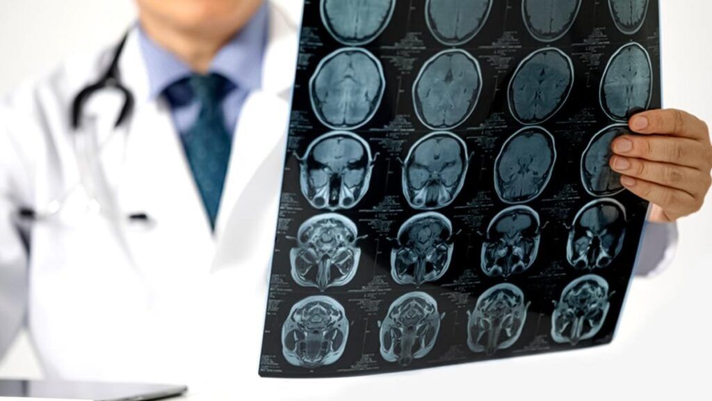 Analizele uzuale pot subestima riscul de accident vascular cerebral: ce spune un nou indicator Monitorizarea colesterolului în mod periodic este o practică uzuală și importantă pentru menținerea sănătății