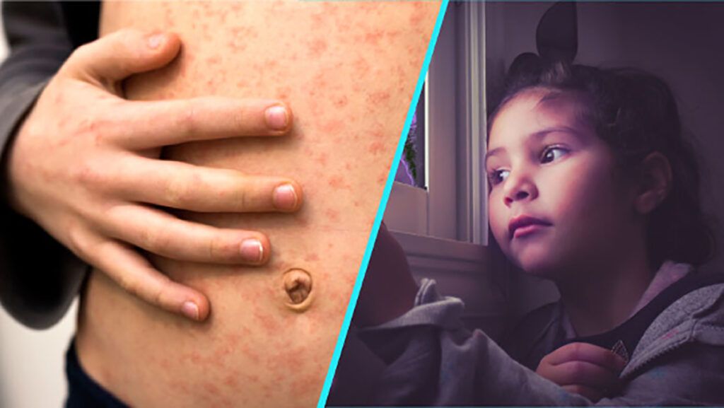 Alertă pe un zbor internațional: Rujeolă la bord, pasagerii expuși sunt căutați de autorități