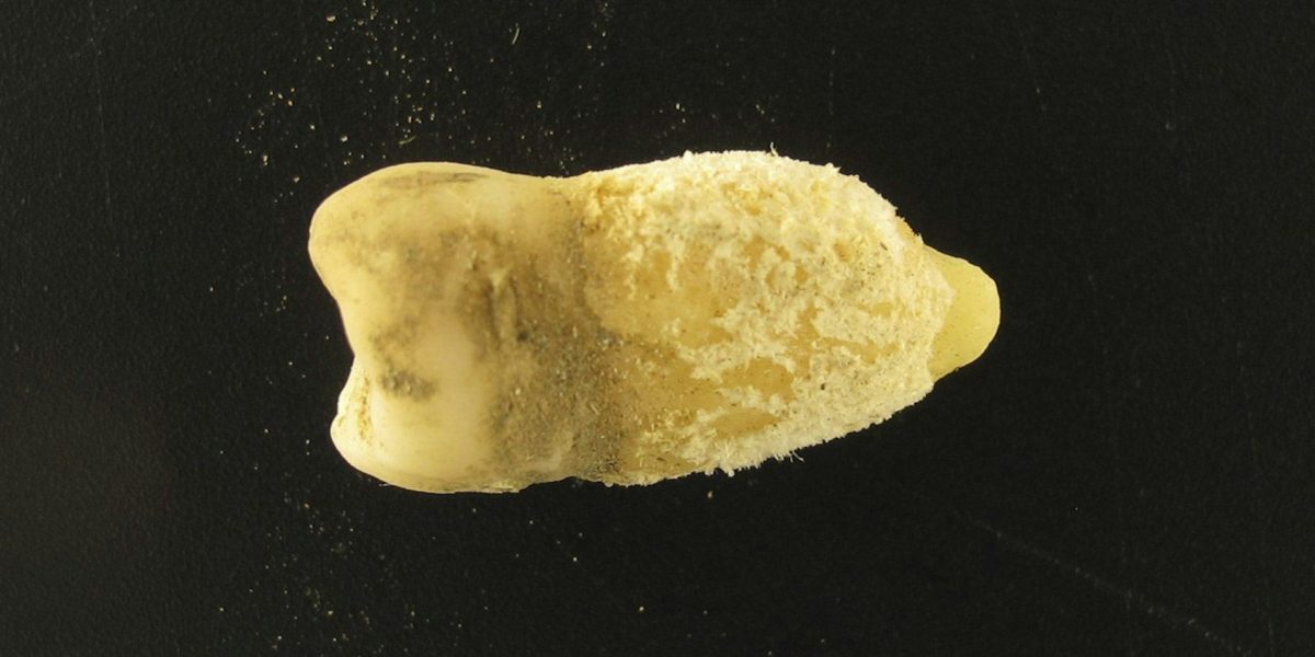 Bacterie de scarlatină, găsită într-o mumie! Descoperirea uimitoare