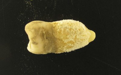 Bacterie de scarlatină, găsită într-o mumie! Descoperirea uimitoare
