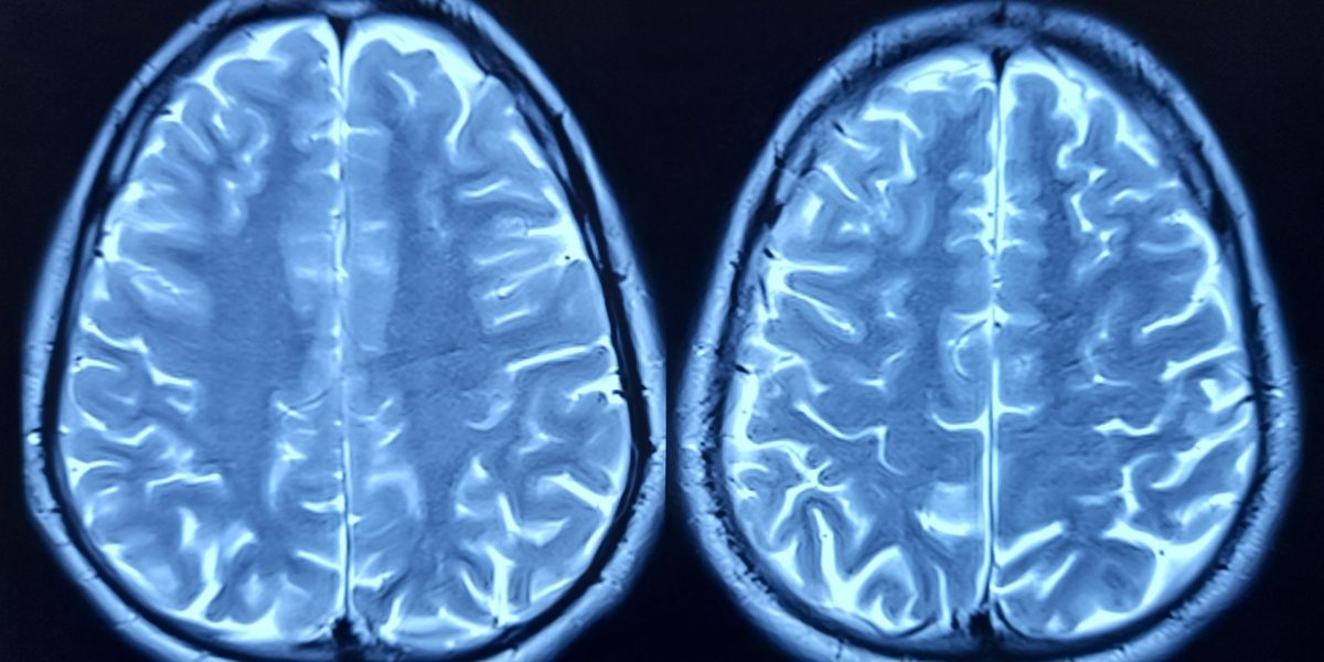 Oamenii de știință au găsit secretul îmbătrânirii creierului