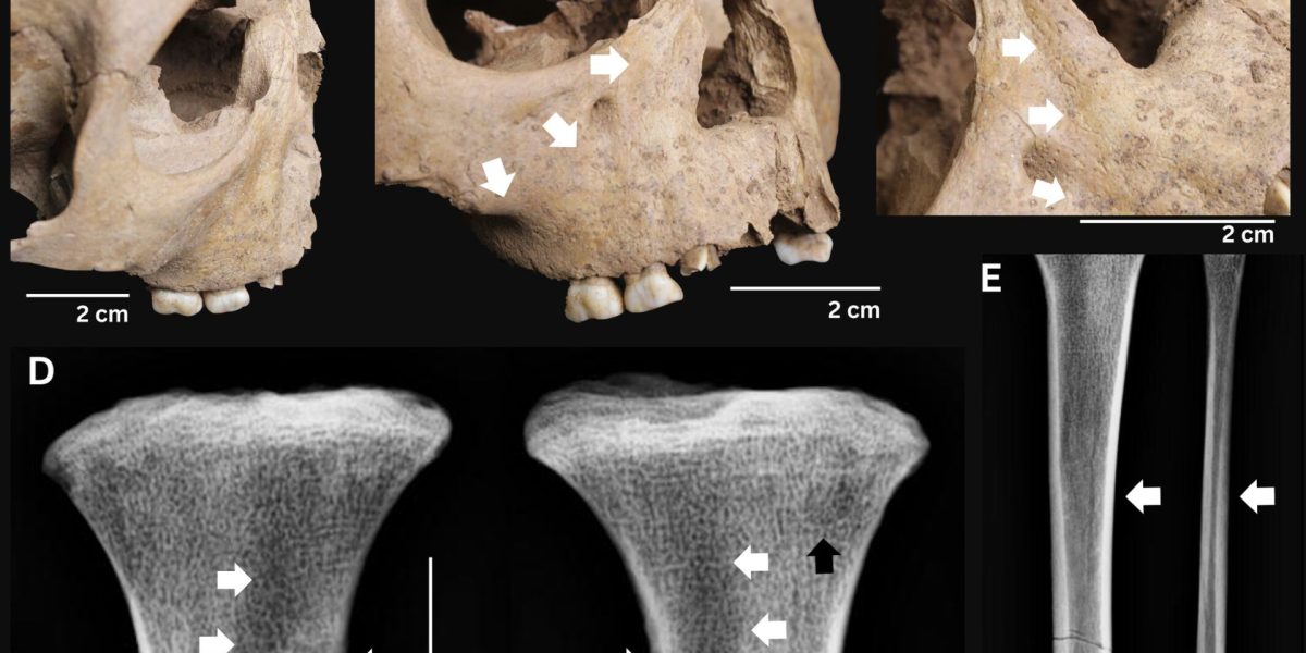 Dinții străvechi dezvăluie boala mortală care bântuia acum 4000 de ani
