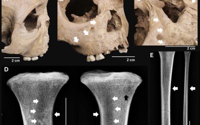 Dinții străvechi dezvăluie boala mortală care bântuia acum 4000 de ani