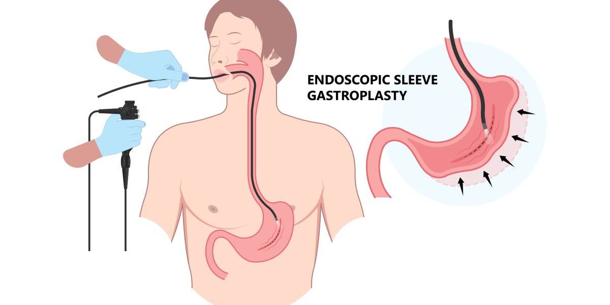 Nouă metodă de slăbire, FĂRĂ CUȚIT: Alternativa endoscopică salvează vieți