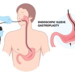 Nouă metodă de slăbire, FĂRĂ CUȚIT: Alternativa endoscopică salvează vieți