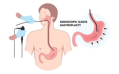 Nouă metodă de slăbire, FĂRĂ CUȚIT: Alternativa endoscopică salvează vieți