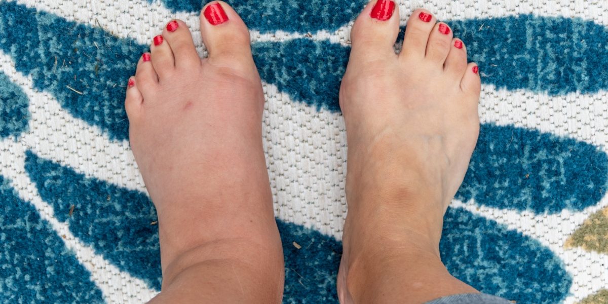 Picioarele, adesea neglijate, pot dezvălui probleme serioase de sănătate