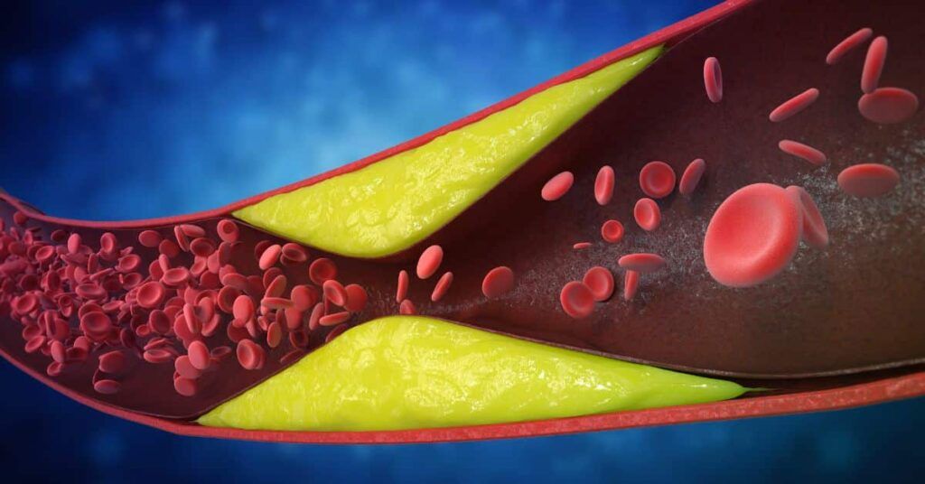 7 semne ignorate: Cardiologii avertizează asupra arterelor blocate, riscuri majore!