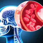Grupa de sânge care crește RISCUL de AVC înainte de 60 de ani