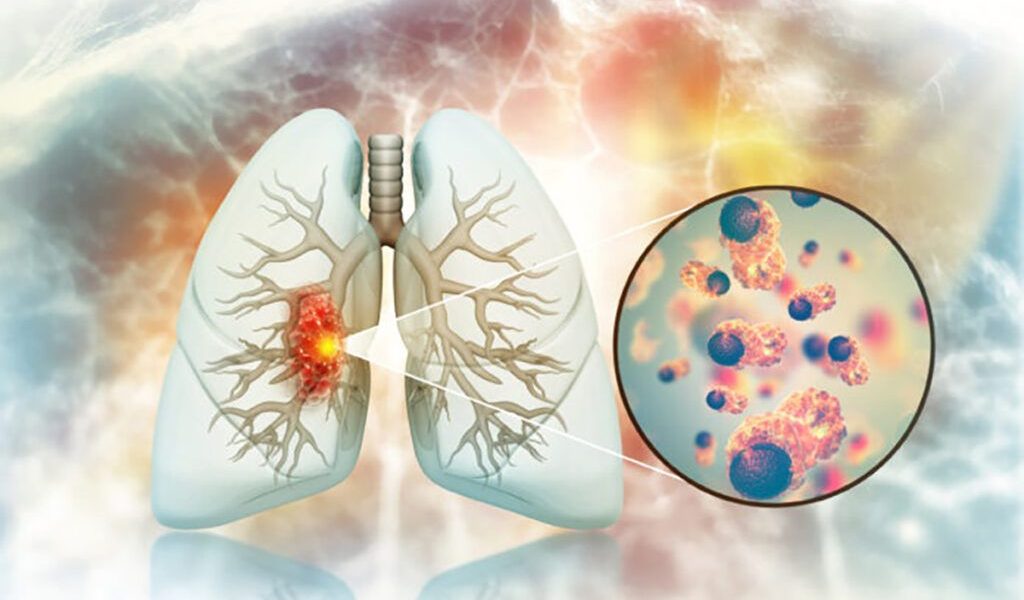 Crește alarmant cancerul pulmonar la nefumători. Medicii, în căutarea cauzelor
