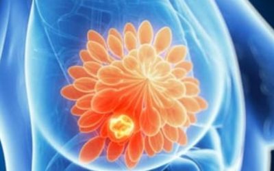 Factorii vitali în recuperarea după cancerul de sân