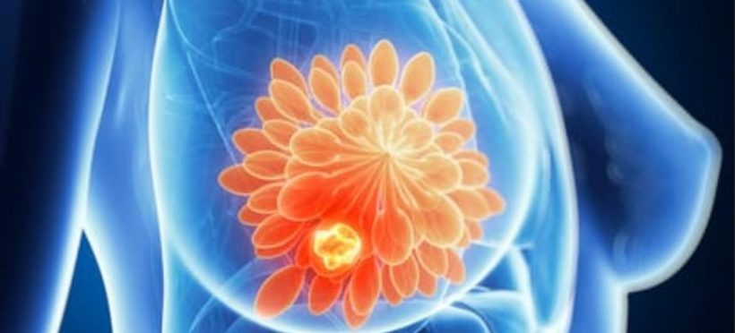 Factorii vitali în recuperarea după cancerul de sân