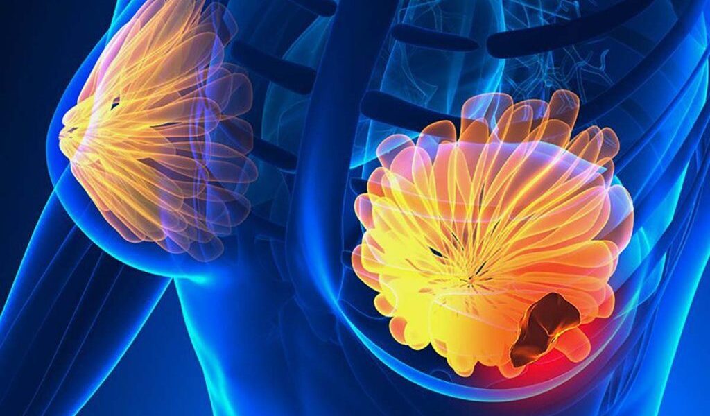 Semnele care te pot salva: 5 simptome ale cancerului de sân