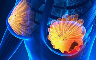 Semnele care te pot salva: 5 simptome ale cancerului de sân