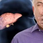 Boala ficatului gras, tratată fără dietă. Descoperirea cercetătorilor șochează lumea medicală