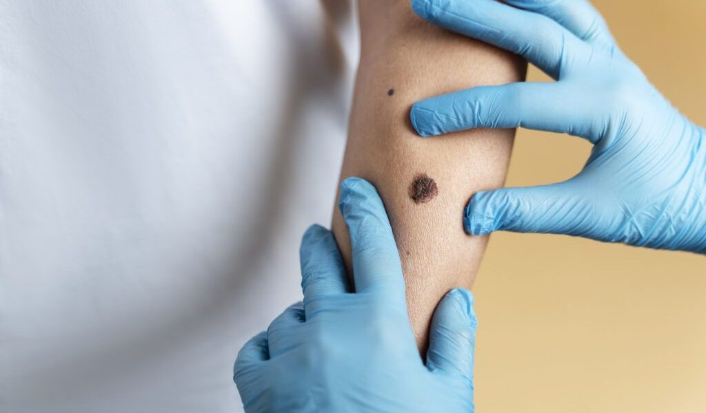 O mamă din Anglia, Josie Thompson, în vârstă de 37 de ani, a pierdut lupta cu cancerul de piele, după ce o aluniță suspectă a fost inițial ignorată