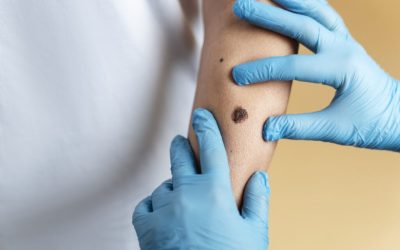 O mamă din Anglia, Josie Thompson, în vârstă de 37 de ani, a pierdut lupta cu cancerul de piele, după ce o aluniță suspectă a fost inițial ignorată