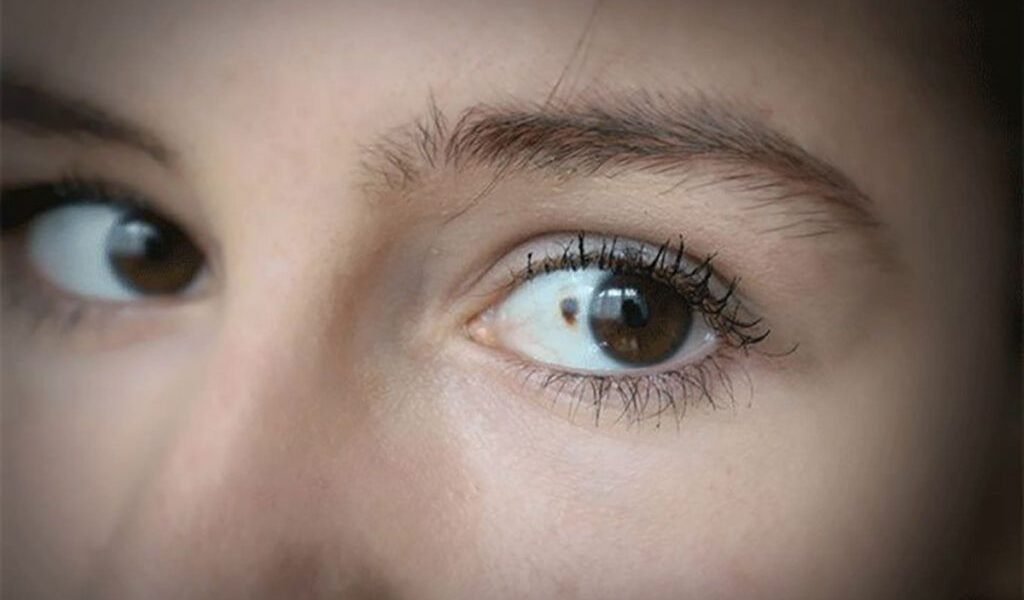 11 semne TĂCUTE de cancer în ochi: Verifică-te! Pot salva viața