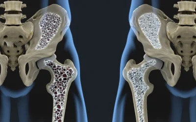 Nou tratament: Oase mai puternice și densitate refăcută, inclusiv în osteoporoză