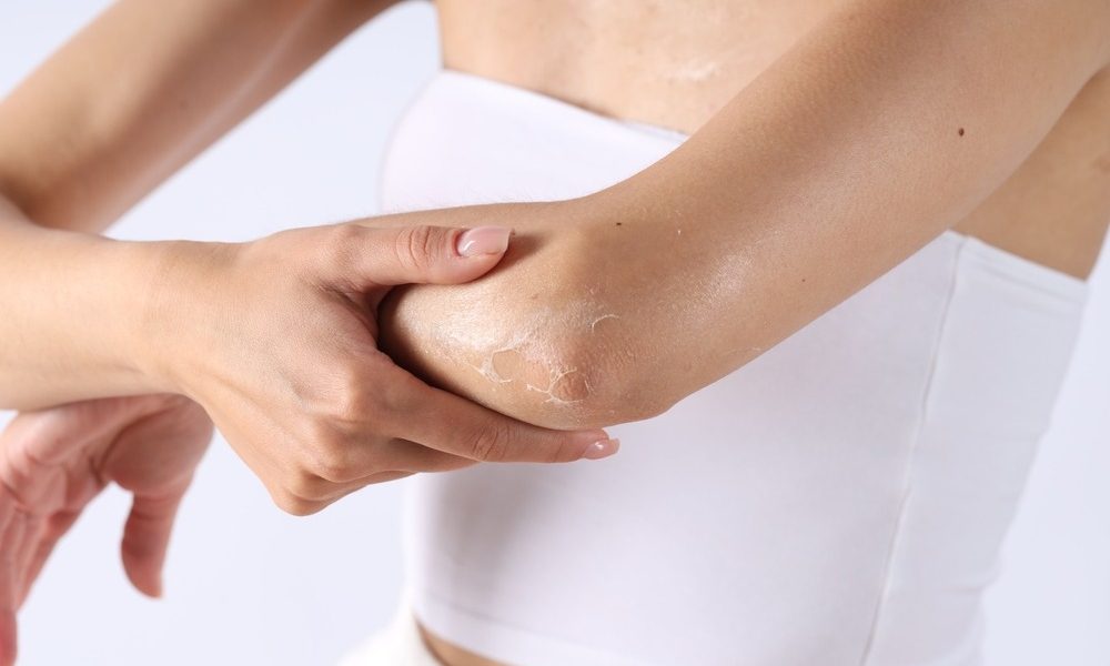 Piele uscată pe brațe și picioare? 5 obiceiuri care distrug epiderma