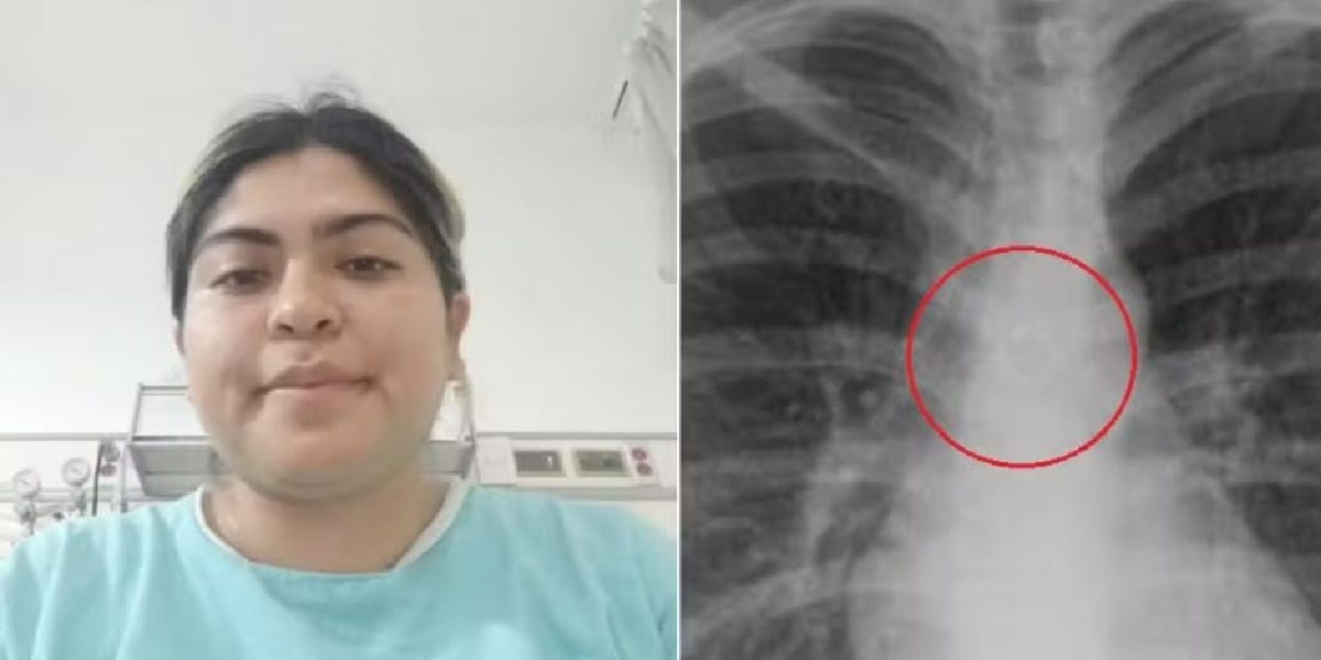 Tânără din MEXIC, șocată: Ce a găsit în plămâni la 26 de ani?