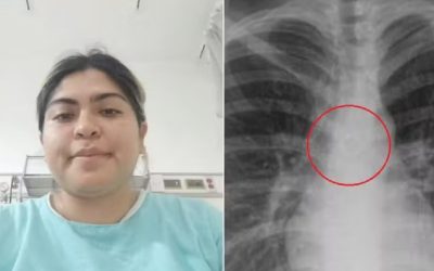 Tânără din MEXIC, șocată: Ce a găsit în plămâni la 26 de ani?