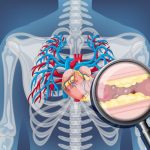 Statine: Greșeala ce crește riscul de infarct ș i AVC