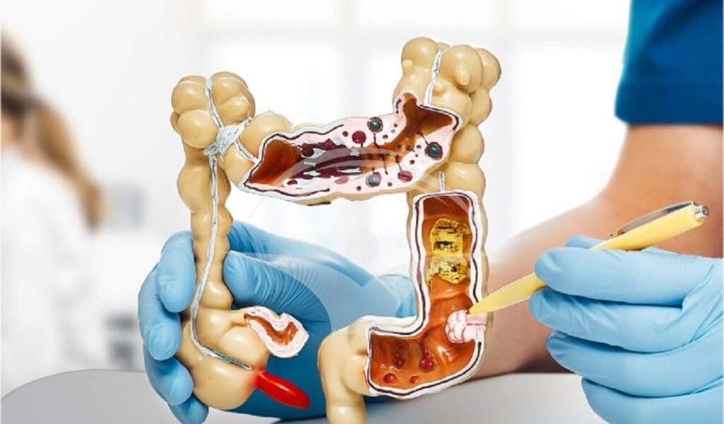 Cancer colon: Medicul dezvăluie semnul crucial