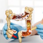Cancer colon: Medicul dezvăluie semnul crucial