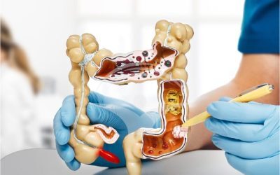 Cancer colon: Medicul dezvăluie semnul crucial